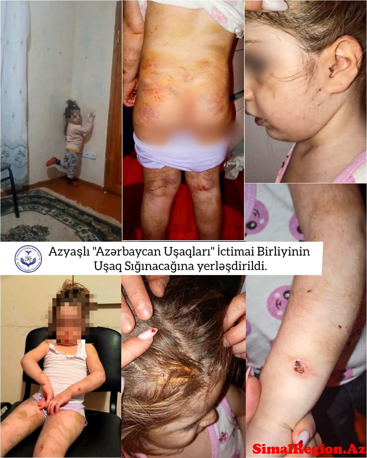 Günlərdir anası tərəfindən döyülən az yaşlı “Azərbaycan Uşaqları” İctimai Birliyinin nəzdində fəaliyyət göstərən Uşaq Sığınacağı Reinteqrasiya Mərkəzinə yerləşdirildi.